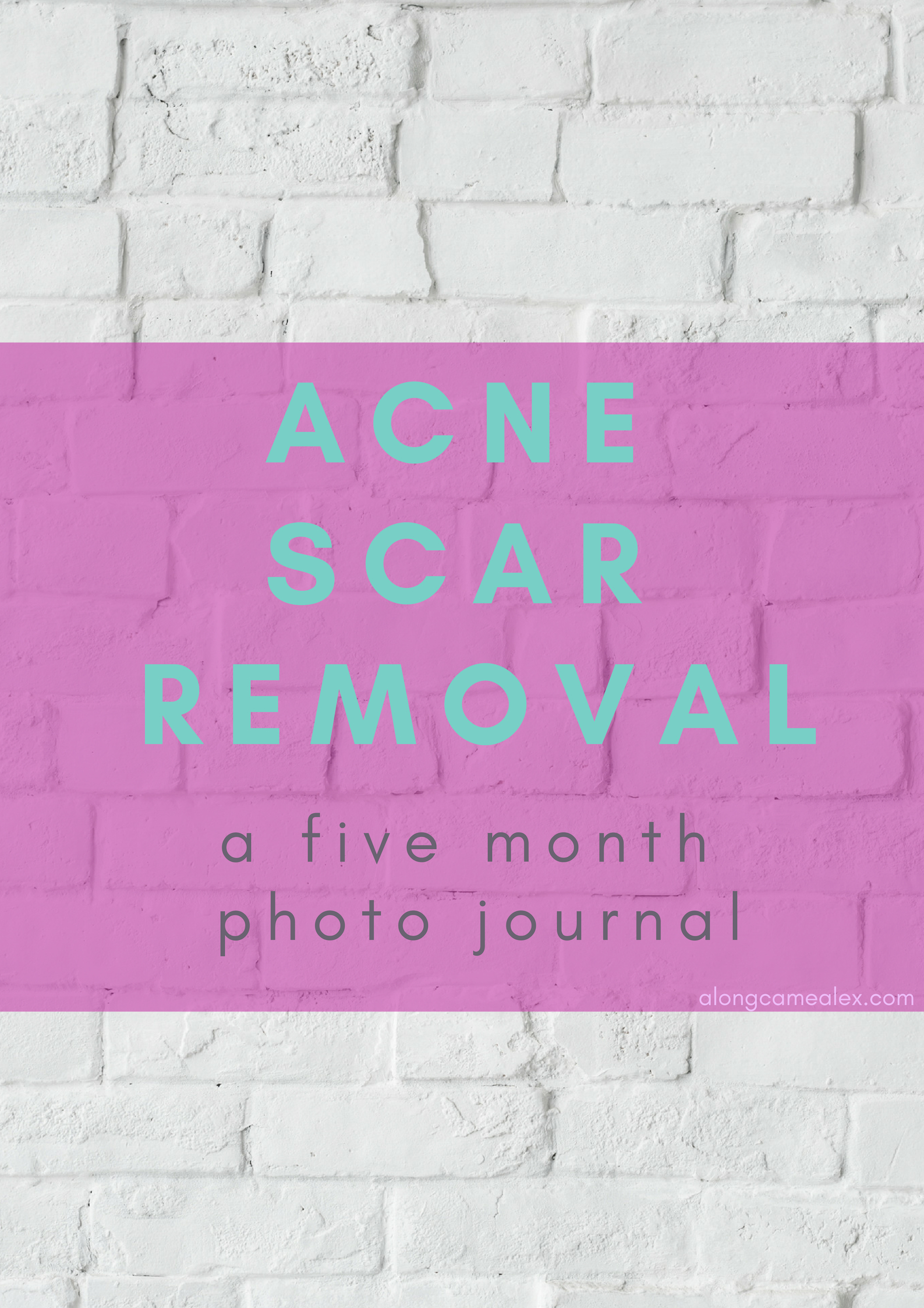 Acne Scar Removal Journey: A 5 month photo journal