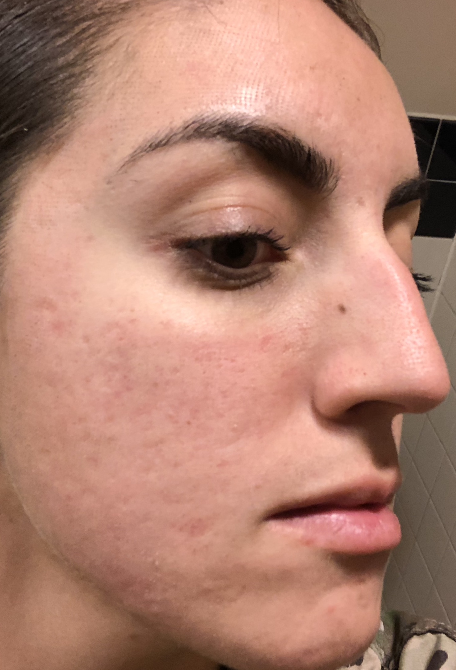 Acne Scar Removal Journey: A 5 month photo journal - Along Came Alex