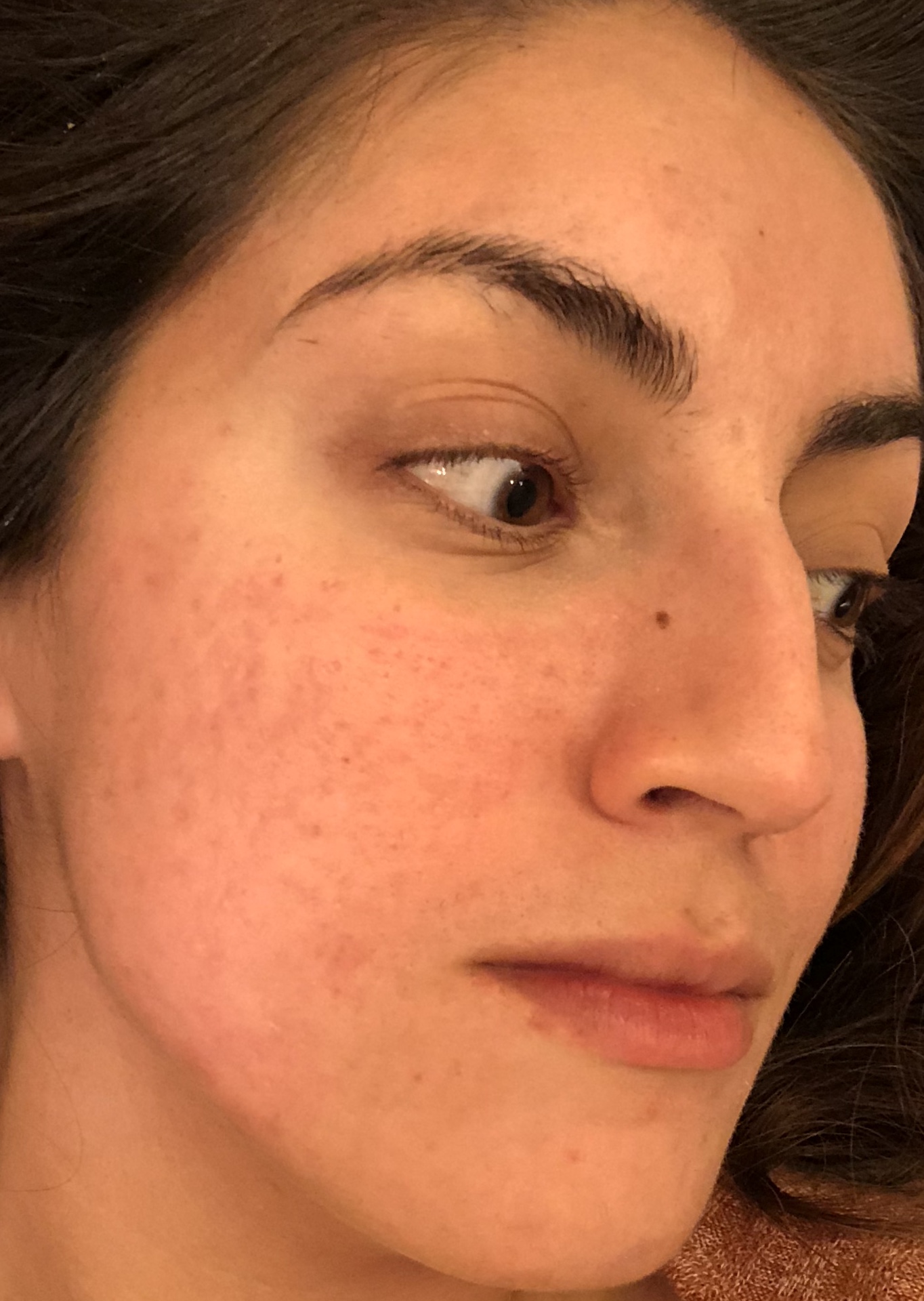 Acne Scar Removal Journey: A 5 month photo journal - Along Came Alex