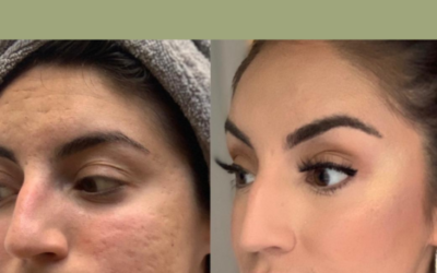 My Journey with Acne, Scars, Accutane, & Scar Removal Treatments